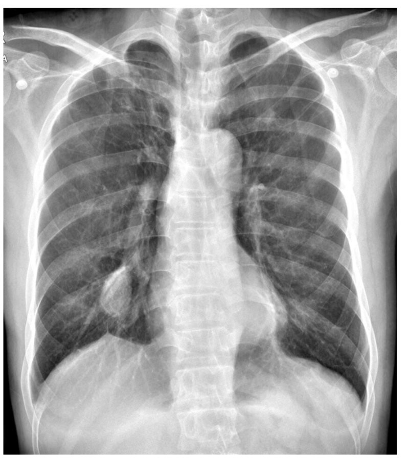 비활동성 폐결핵 증례, 흉부x선 사진, tuberculoma, subpleural bullae, 폐기종, micronodule ...
