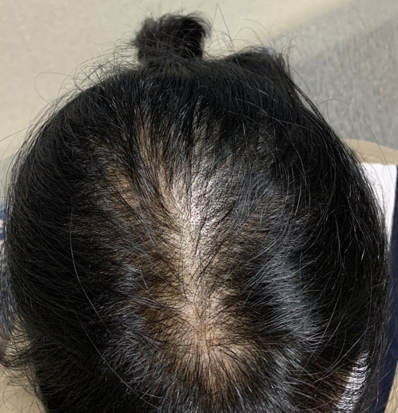 미녹시딜정 미녹스5 록시딜 해외직구에 대한 관세사무실 답변 : 네이버 블로그