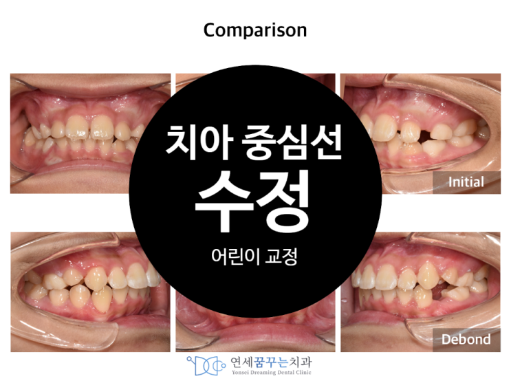 중심선이 안 맞고 어금니가 반대로 물리는 친구의 어린이 교정