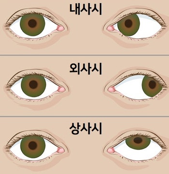 간헐적 사시(외사시, 내사시, 상사시) 교정, 수술 없이 치료하기 / 사시 증상, 성인 외사시 : 네이버 블로그 간헐적 사시(외사시, 내사시, 상사시) 교정, 수술 없이 치료하기 / 사시 증상, 성인 외사시 : 네이버 블로그
