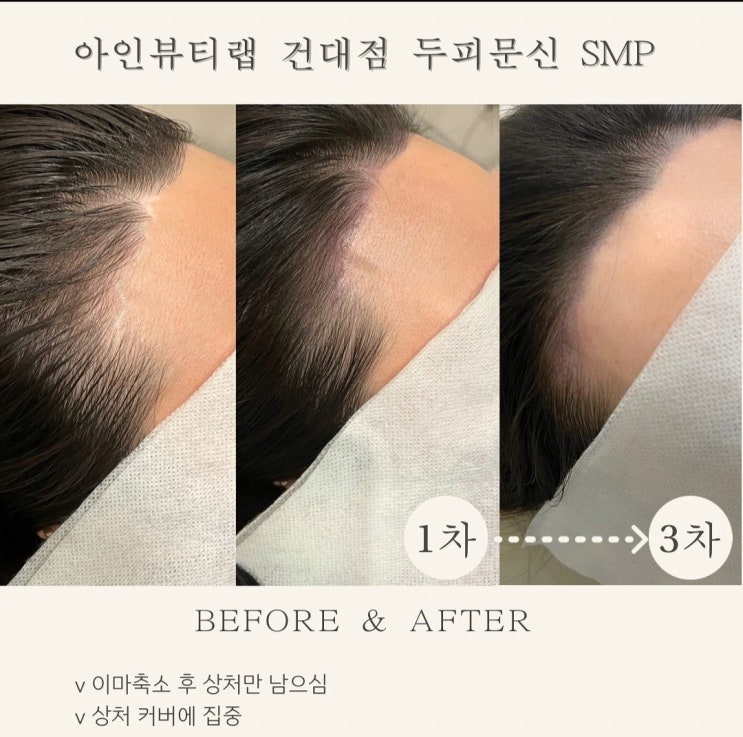  [건대두피문신smp] 아인뷰티랩건대점에서 건대입구눈썹문신 건대반영구 두피문신 완벽한 비포 에프터