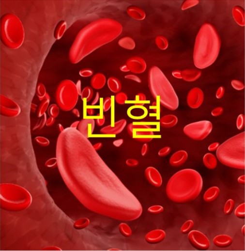  빈혈의 원인과 빈혈에 좋은 음식