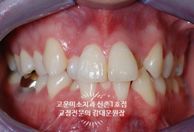 심한 치열불규칙 총생 덧니 발치 블랙트라이앵글 고려한 교정치료 신촌치아교정 고운미소신촌1호점 치료증례