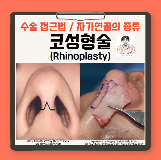  코성형술(Rhinoplasty) (2) - 비내(closed)/비외(open)접근법, 자가 연골의 종류(비중격 연골, 귀 연골, 늑연골)