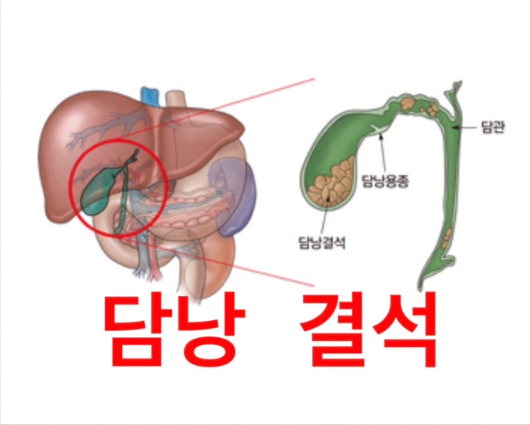  담낭 결석 / 만성담낭염 돼서 담낭절제술 받은 이야기