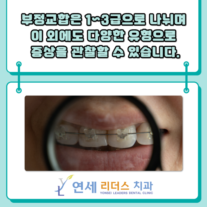 어린이 부정교합의 종류에는 어떤 것들이 있나요? 2