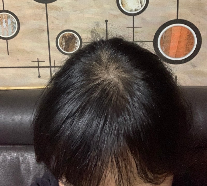 미녹시딜정 미녹스5 저용량 복용 효과 348일째 : 네이버 블로그