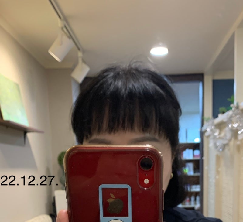 미녹시딜정 미녹스5 저용량 복용 효과 348일째 : 네이버 블로그