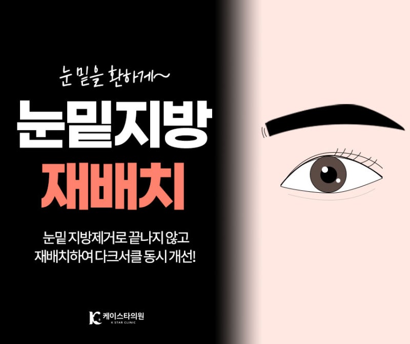 광주눈밑지방재배치로 칙칙한 눈매를 환하게