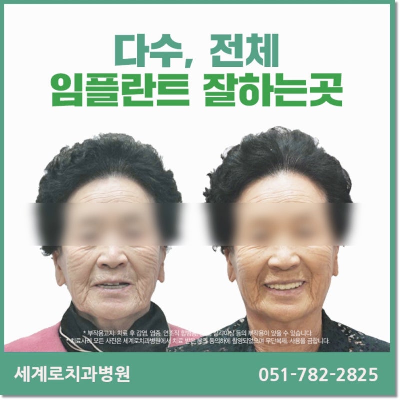 부산 임플란트 보험 적용 대상이 궁금해서요?