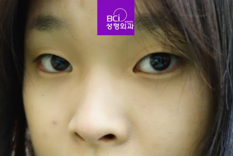 안검하수수술비용 졸려보이는 눈매의