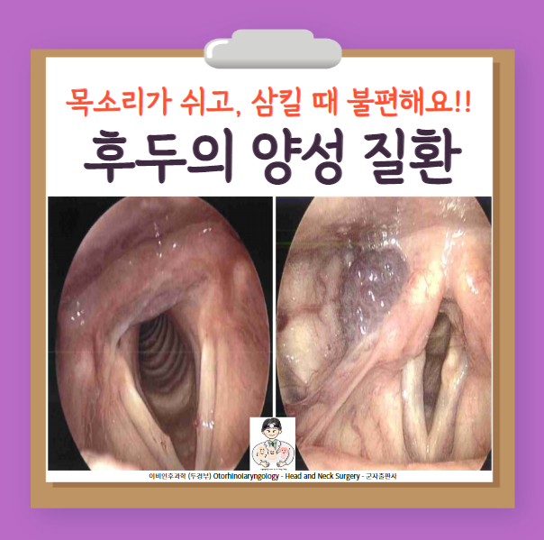  후두의 양성 질환 (1) - 모세혈관 확장증(capillary ectasia), 후두 혈관종(hemangioma), 림프기형(lymphatic malformation)