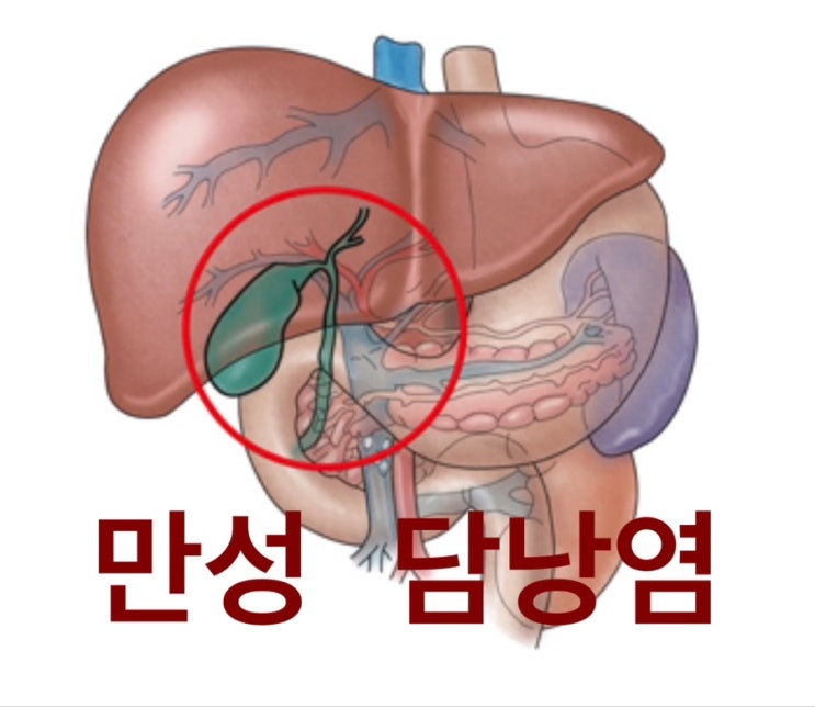  만성 담낭염 / 담석증으로 담낭 절제술 받은 이야기 2