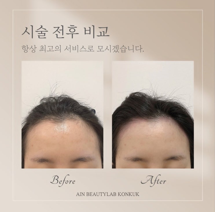  [건대입구두피문신] 건대두피문신 건대smp 비포에프터 너무나 자연스럽게 채우는 시술 후기! 아인뷰티랩건대점