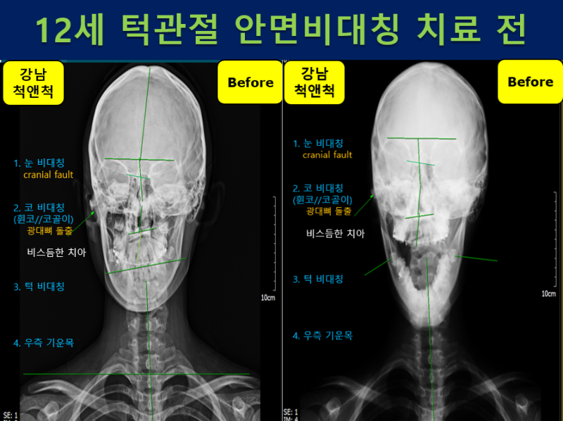 (강남역 도수치료) 중학생 두통과 피로감(안면비대칭, 역C목 척추측만증) 하악관절+척추마사지가 필요합니다. 7