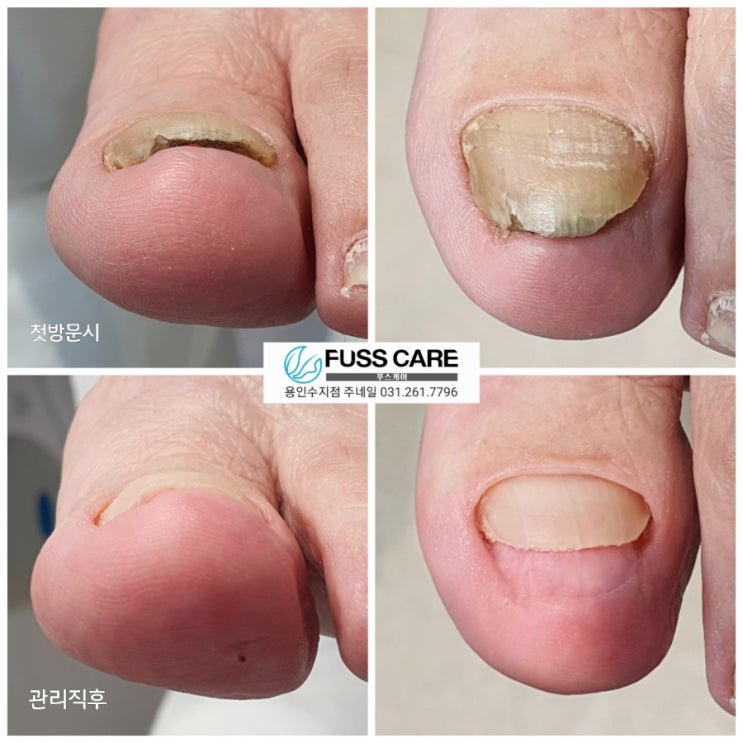 자라지 않고 두껍게 변한 발톱때문에 얄말신고 걸으면 아파요./성남수원수지보정동백죽전동/주네일푸스케어용인수지점/파고드는내성발톱변형전문점 자라지 않고 두껍게 변한 발톱때문에 얄말신고 걸으면 아파요./성남수원수지보정동백죽전동/주네일푸스케어용인수지점/파고드는내성발톱변형전문점