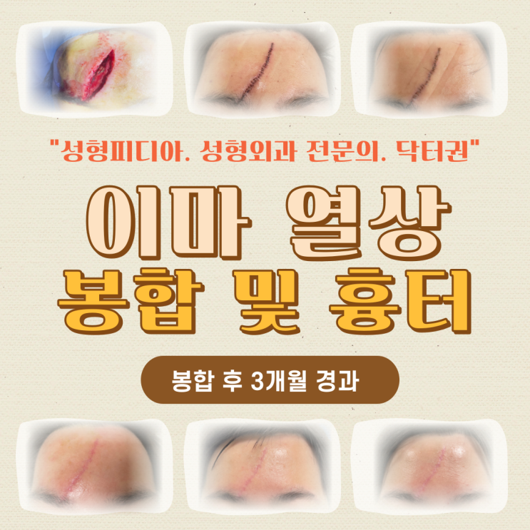  [안면열상] 이마 열상의 봉합 및 흉터, 이마가 찢어졌어요. (feat. 이마 신경 손상, 신경문합술)