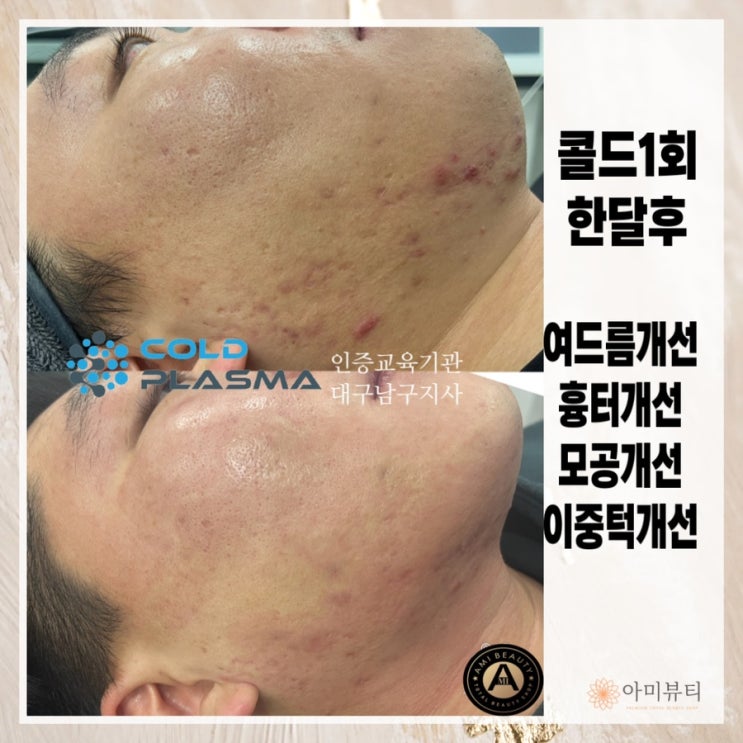  지긋지긋한 악성여드름 , 여드름흉터 고민이시라면 콜드플라즈마 로  해결하세요 (대구아미뷰티)