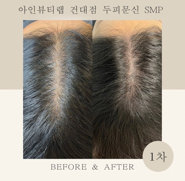  [건대두피문신 1차 시술]만 했는데 이정도라고? 건대입구두피문신 아인뷰티랩건대점