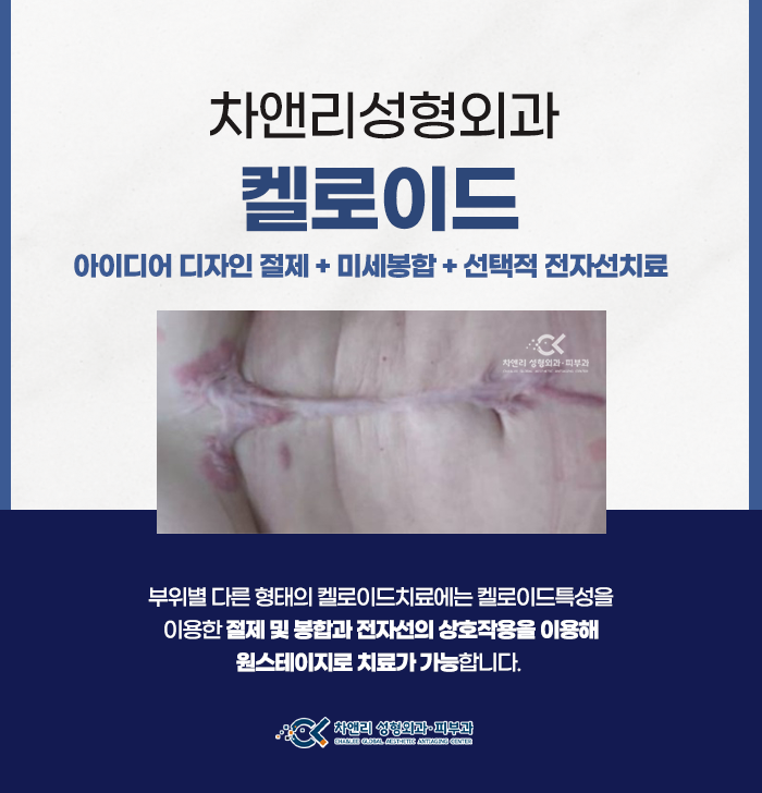 비후성반흔 켈로이드 완치하려면