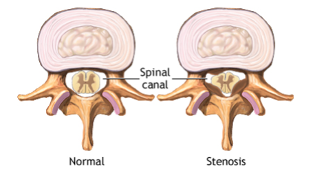  척추관 협착증(stenosis)