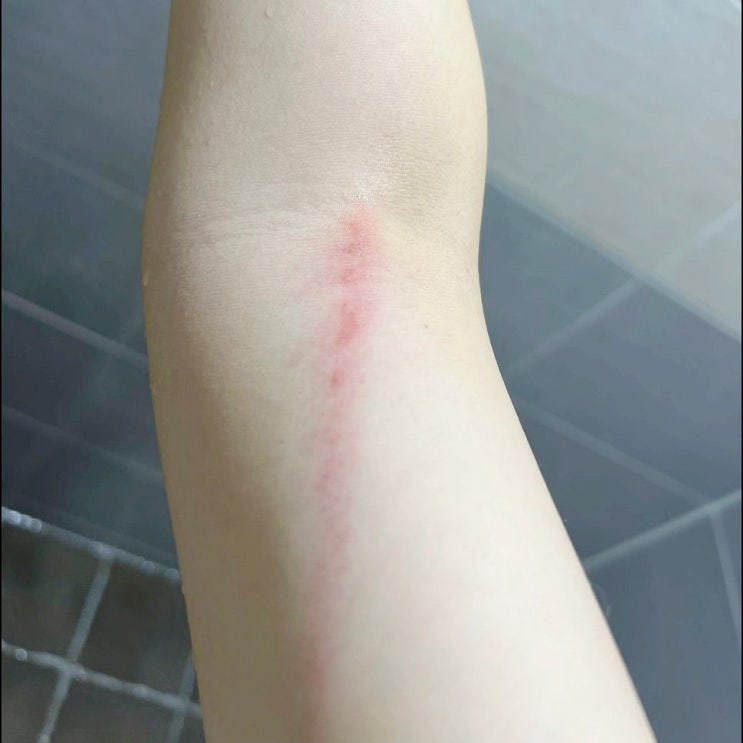 힐텀스카겔 흉터연고 일자별 기록, 내돈내산 후기
