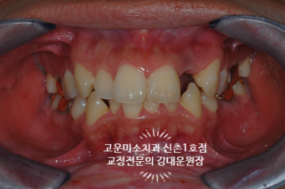  두번째 앞니 결손 발치교정 입술돌출 불규칙한 치열 신촌교정치과 고운미소 신촌1호점 치료증례