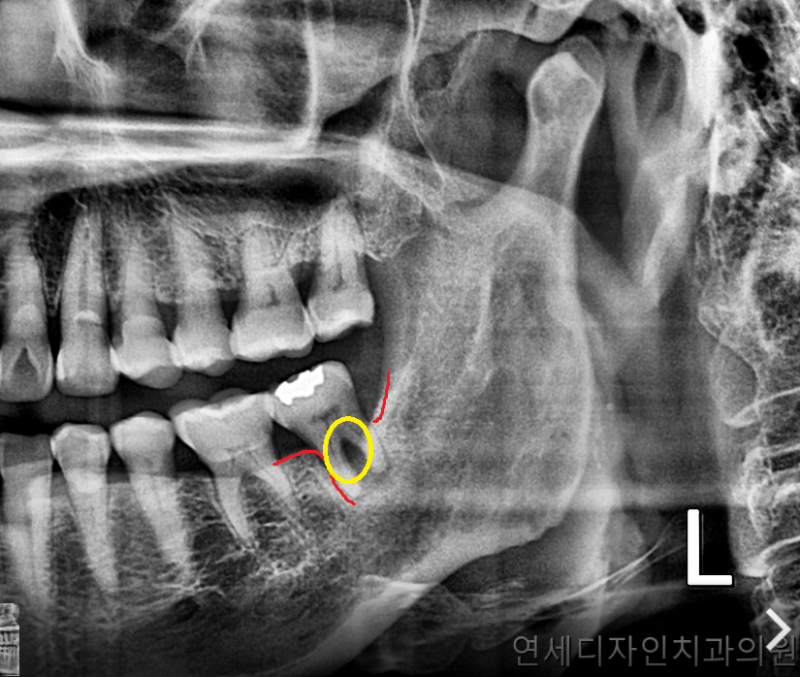 영등포 임플란트 새해 계획으로 치과 치료는 어떠세요?