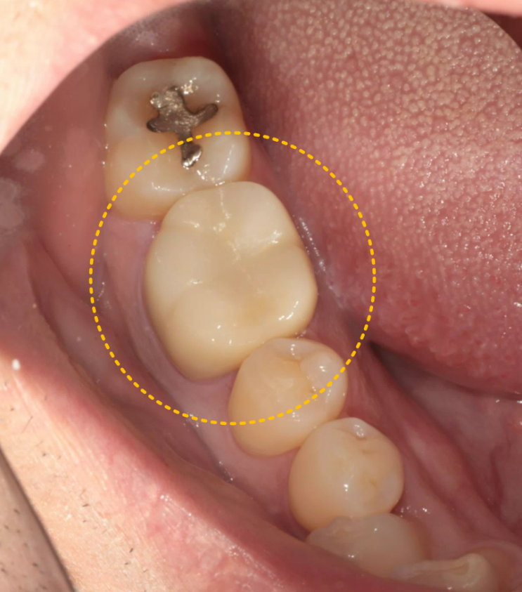 치아가 씹을 때 아플 때 - 치아크랙(균열) 하남미사치과/상일동치과/강일동치과