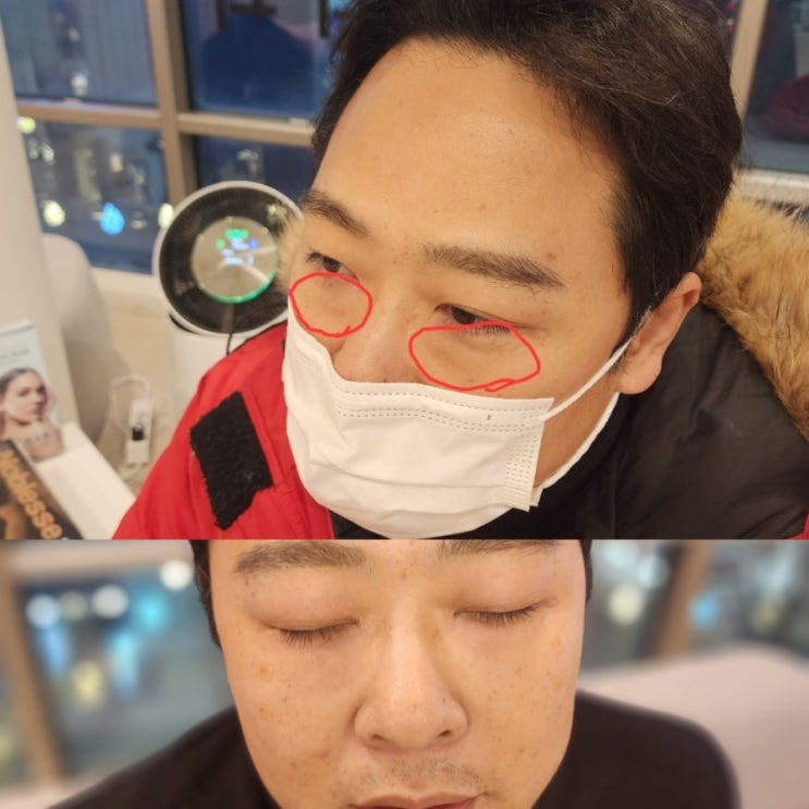  남자 눈밑지방재배치레이저+다크서클 필러 3cc 후기 통증 부작용
