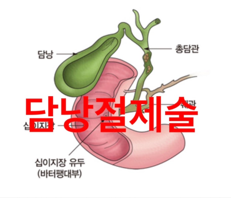  담낭 제거 수술  /  단일 복강경 담낭절제술 후기