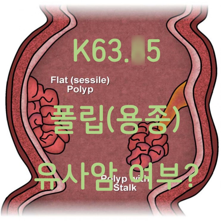  K63.5 결장의 폴립진단과 조직검사 결과에 따라 유사암진단비 검토!
