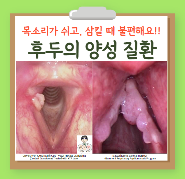  후두의 양성 질환 (2) - 접촉성 육아종(Contact granuloma), 후두 유두종(Laryngeal papilloma), 재발성 호흡기 유두종증(RRP)