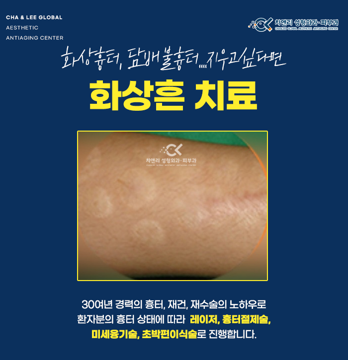  학교폭력에 의한 화상흉터