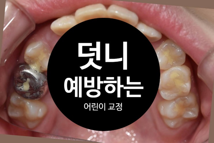 덧니를 예방하는 방법, 어린이 교정으로 올바른 교합 만들기 덧니를 예방하는 방법, 어린이 교정으로 올바른 교합 만들기