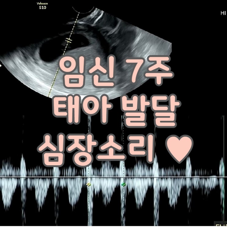 임신 기록 7주차 태아 발달 및 초음파 진료 심장소리 콩콩콩