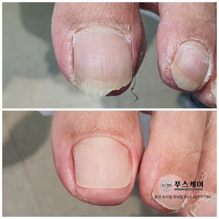 살을 파고드는발톱 단 1회 보이지않았던 히든네일 컷팅만으로도 이렇게 바뀝니다./ 문제성 손발톱 전문네일샵 주네일 푸스케어 용인수지점 살을 파고드는발톱 단 1회 보이지않았던 히든네일 컷팅만으로도 이렇게 바뀝니다./ 문제성 손발톱 전문네일샵 주네일 푸스케어 용인수지점