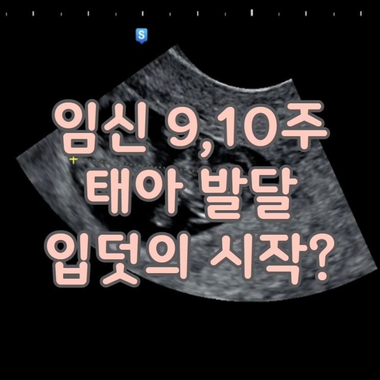 임신 기록 9-10주차 아기 발달 초음파 태아 산부인과 입덧