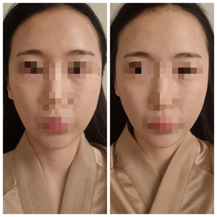  약손명가 잠실역점 윤곽관리 1회만으로 얼굴라인 정리