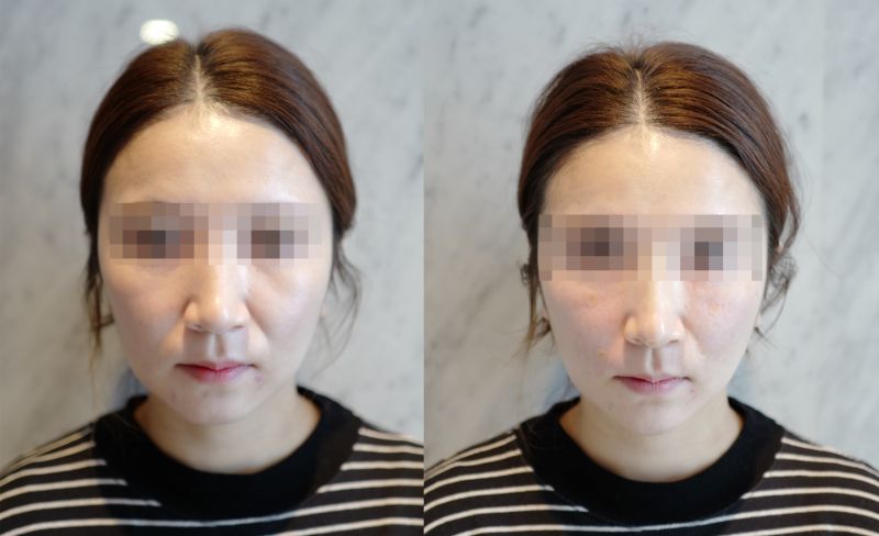 엄마생일선물 청담피부과 팔자 주름 실 리프팅 이마 보톡스 리뷰