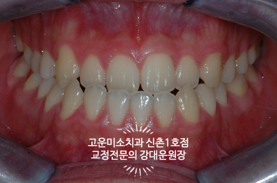  3급 부정교합 주걱턱 반대교합 비대칭 비발치 비수술교정치료 신촌치아교정 고운미소치과 신촌1호점 치료증례