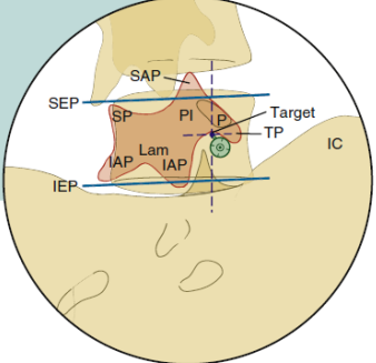 경추간공 경막외 스테로이드 주사(TransForaminal Epidural Steroid Injection, TFESI ...