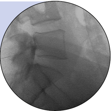 경추간공 경막외 스테로이드 주사(TransForaminal Epidural Steroid Injection, TFESI ...