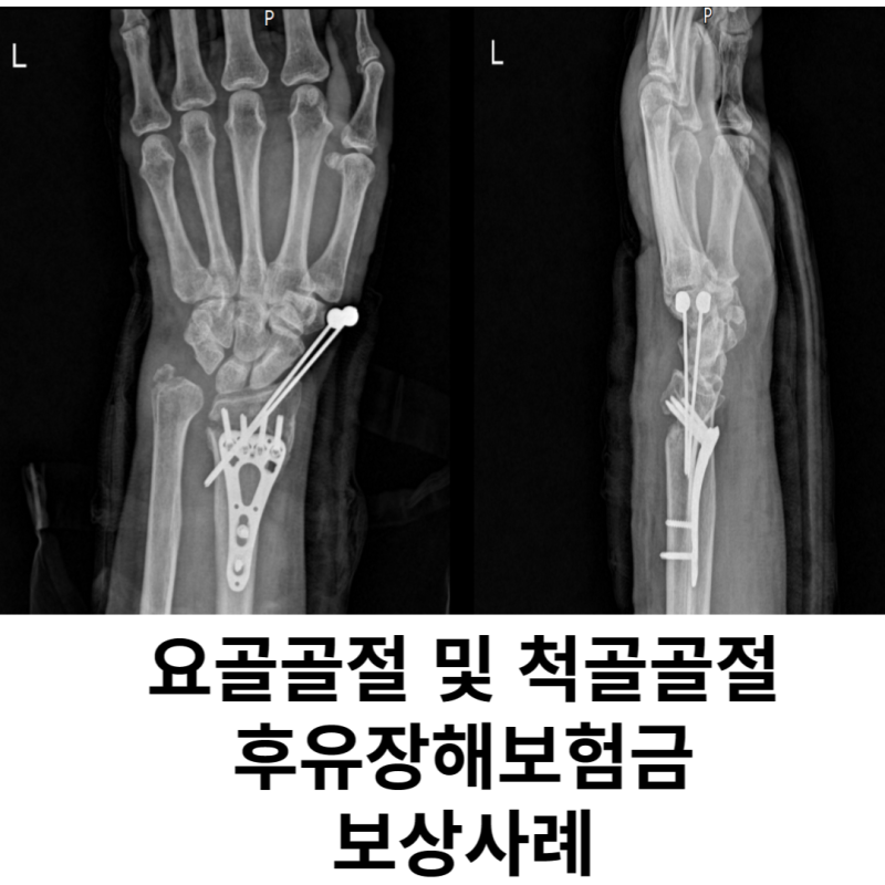 요골골절 및 척골골절 후유장해보험금 보상받는 방법 : 네이버 블로그
