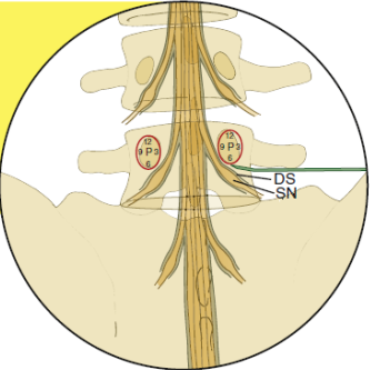 경추간공 경막외 스테로이드 주사(TransForaminal Epidural Steroid Injection, TFESI ...