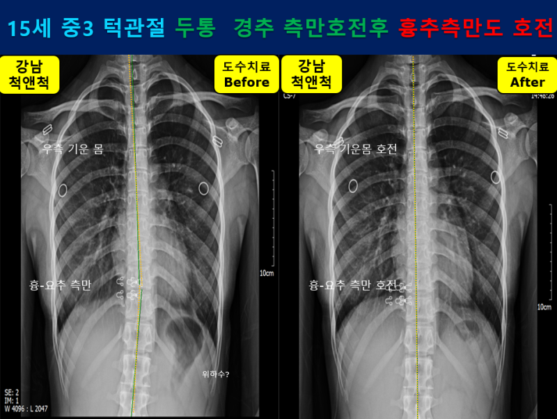 (강남역 도수치료) 중학생 두통과 피로감(안면비대칭, 역C목 척추측만증) 하악관절+척추마사지가 필요합니다. 4