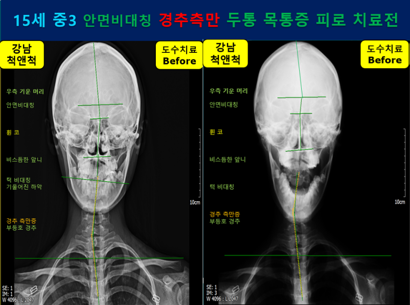 (강남역 도수치료) 중학생 두통과 피로감(안면비대칭, 역C목 척추측만증) 하악관절+척추마사지가 필요합니다. 1