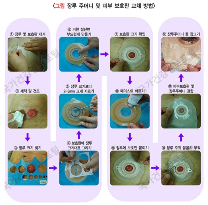 인공항문, 장루 주머니 (간호, 교환방법) : 네이버 블로그