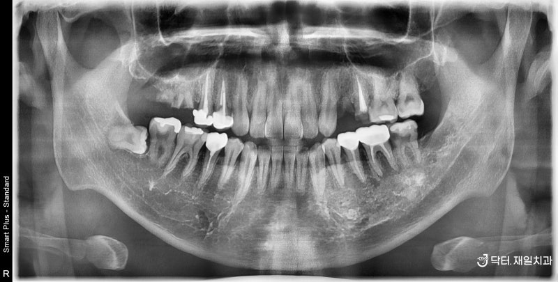 20대와 풀임플란트의 차이점 2