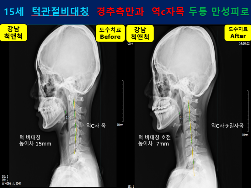 (강남역 도수치료) 중학생 두통과 피로감(안면비대칭, 역C목 척추측만증) 하악관절+척추마사지가 필요합니다. 3